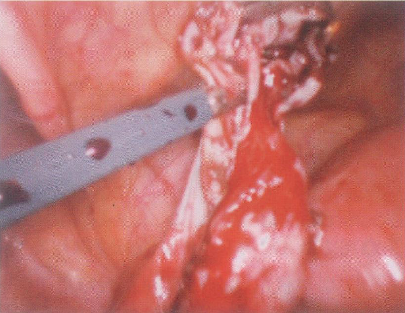 一、卵巢子宫内膜异位囊肿剥除术